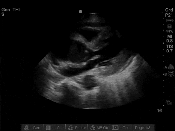 Wide aortic root, sometimes pericardial effusion