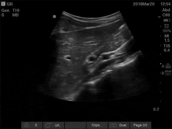 ultrasound screen of finding the gallbladder