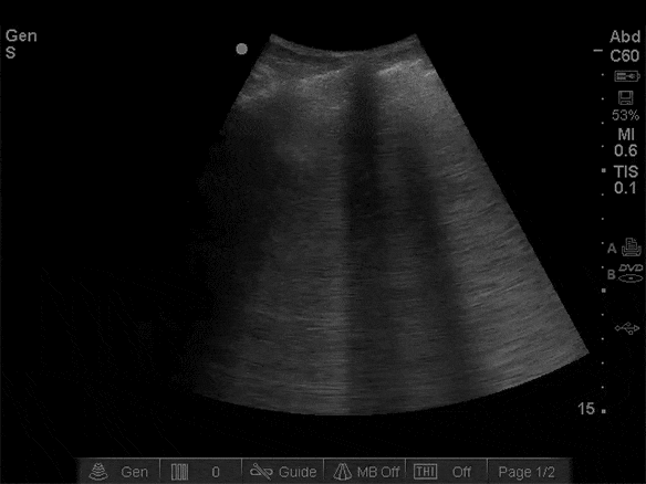 Pulmonary contusion presents with B-lines