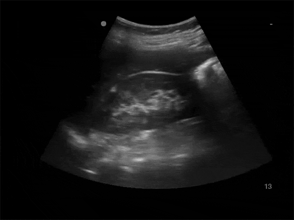 normal kidney ultrasound image